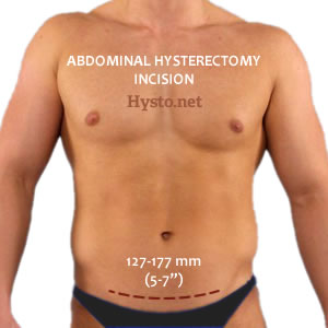 laparoscopic hysterectomy scars